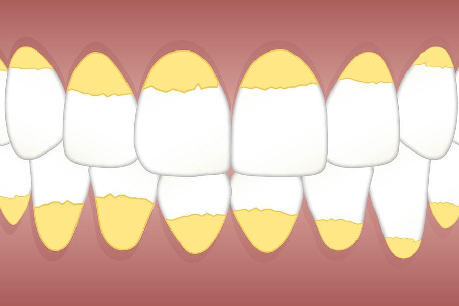 Zobni kamen Luxdental