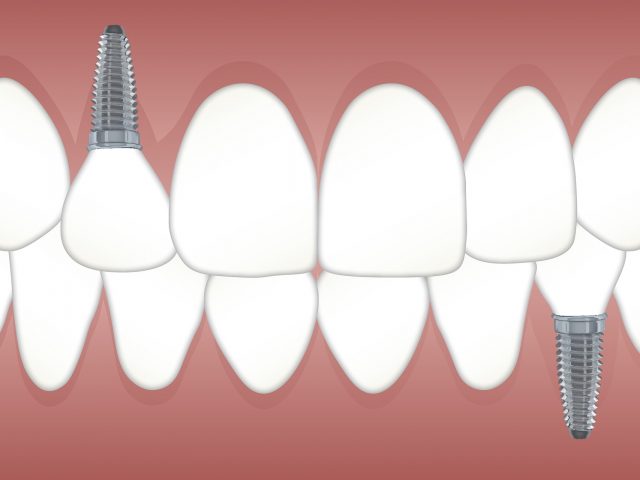 Zobni implantat za zdravje ustne votline